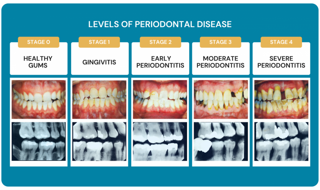 How To Prevent And Manage Gum Disease - Dental Care Stamford